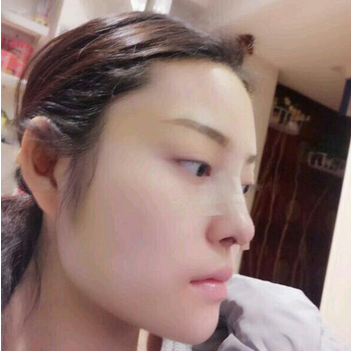 武漢維納斯整形醫(yī)院韓國濤醫(yī)生做鼻綜合整形怎么樣？附鼻綜合整形案例