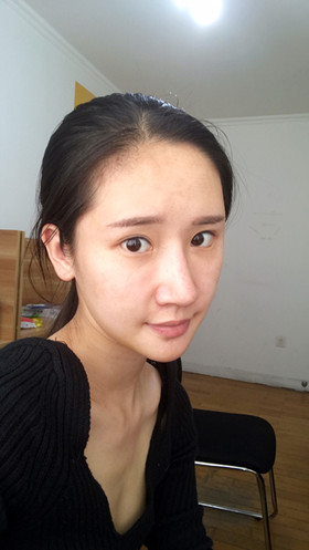 湛江澳泰整形醫(yī)院彭鑫醫(yī)生做自體脂肪豐蘋果肌+太陽穴案例效果對比圖