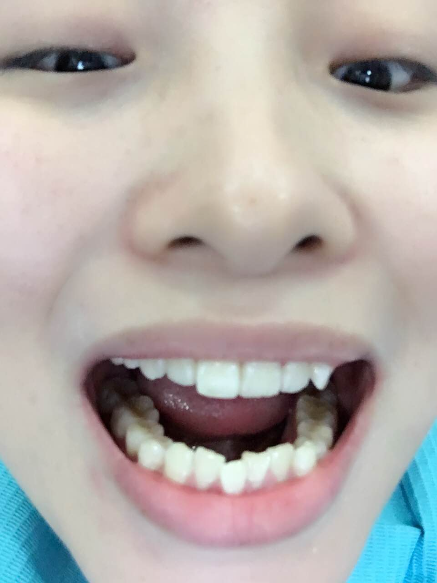 鄭州壹加壹整形醫(yī)院楊永利醫(yī)生做牙齒隱形矯正怎么樣？附牙齒隱形矯正案例