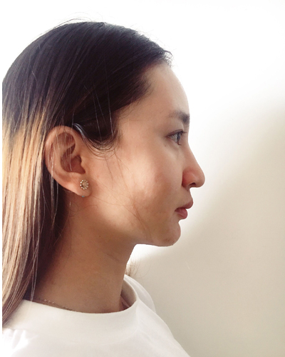 武漢維納斯整形醫(yī)院趙瑾醫(yī)生做玻尿酸墊下巴怎么樣？附玻尿酸墊下巴案例