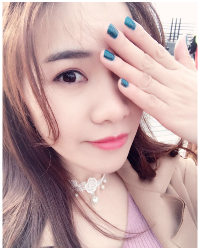 營口臻美醫(yī)療整形醫(yī)生閆迎軍做雙眼皮效果怎么樣？附雙眼皮案例對比圖