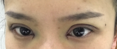 長春麥西美嘉整形醫(yī)生王圣博做雙眼皮手術(shù)效果怎么樣？附雙眼皮案例