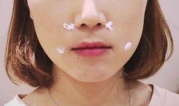 信陽東方藝美容醫(yī)院劉力萌做玻尿酸去法令紋效果怎么樣？附案例效果對(duì)比圖