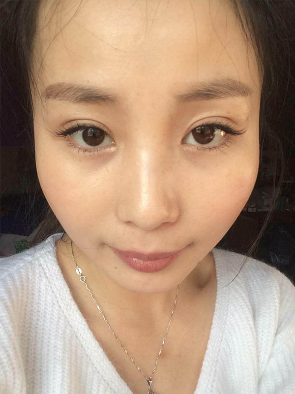 桂林新華醫(yī)療美容醫(yī)生李新華做雙眼皮手術怎么樣？李新華雙眼皮手術案例