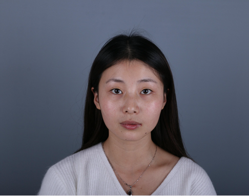 桂林新華醫(yī)療美容醫(yī)生李新華做雙眼皮手術怎么樣？李新華雙眼皮手術案例