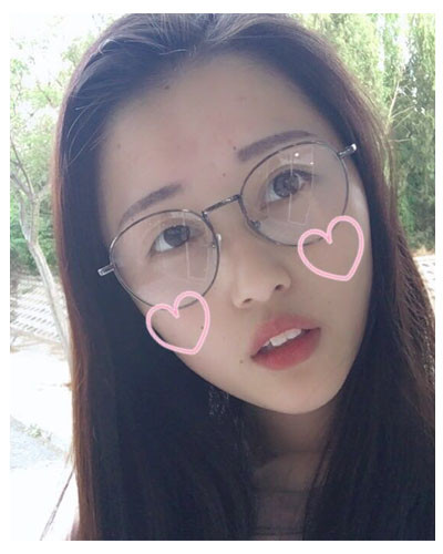 義烏傅氏口腔醫(yī)生朱雨晴做牙齒隱形矯正效果怎么樣？附牙齒隱形矯正案例