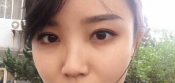 長沙微笑醫(yī)療整形醫(yī)生段雙軍做切開雙眼皮+開內(nèi)眼角效果怎么樣？附案例