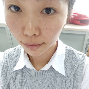 珠海蒂伊醫(yī)療整形醫(yī)生廖俊凱做激光祛斑效果怎么樣？附激光祛斑案例效果圖