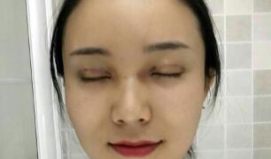 長沙微笑醫(yī)療整形醫(yī)生段雙軍做切開雙眼皮+開內(nèi)眼角效果怎么樣？附案例