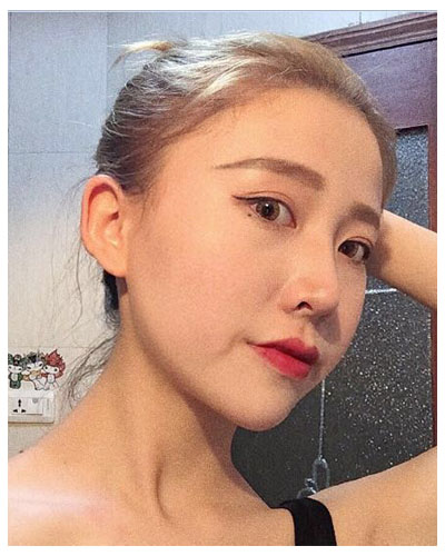珠海海大整形美容外科黃發(fā)醫(yī)生做面部吸脂怎么樣？附面部吸脂案例
