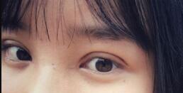 長沙微笑醫(yī)療整形醫(yī)生段雙軍做切開雙眼皮+開內(nèi)眼角效果怎么樣？附案例