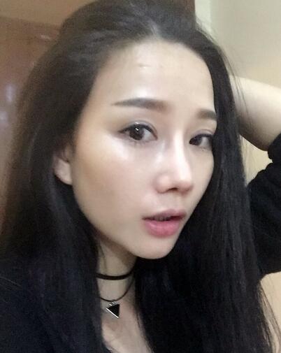 西安陽(yáng)光整形醫(yī)院邵萍醫(yī)生做鼻綜合整形怎么樣？附鼻綜合整形案例