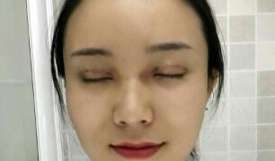 長沙微笑醫(yī)療整形醫(yī)生段雙軍做切開雙眼皮+開內(nèi)眼角效果怎么樣？附案例