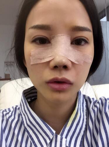 西安陽光整形醫(yī)院邵萍醫(yī)生做鼻綜合整形怎么樣？附鼻綜合整形案例