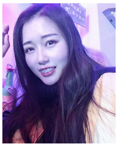 義烏傅氏口腔醫(yī)生朱雨晴做牙齒隱形矯正效果怎么樣？附牙齒隱形矯正案例
