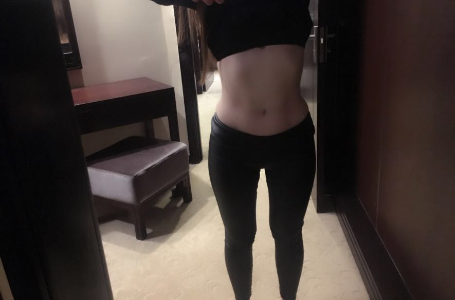 肇慶華美整形醫(yī)院陳巍醫(yī)生做腰腹吸脂效果怎么樣？附腰腹吸脂案例