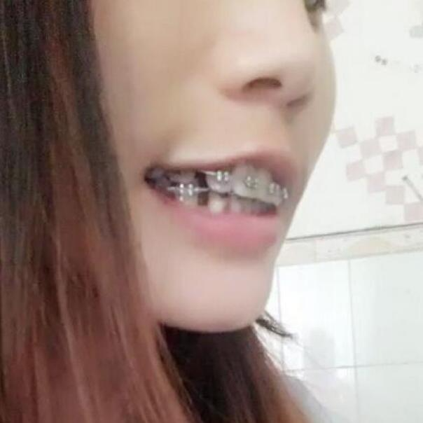 武漢立美整形醫(yī)院張智星醫(yī)生做牙齒矯正效果怎么樣？附牙齒矯正案例