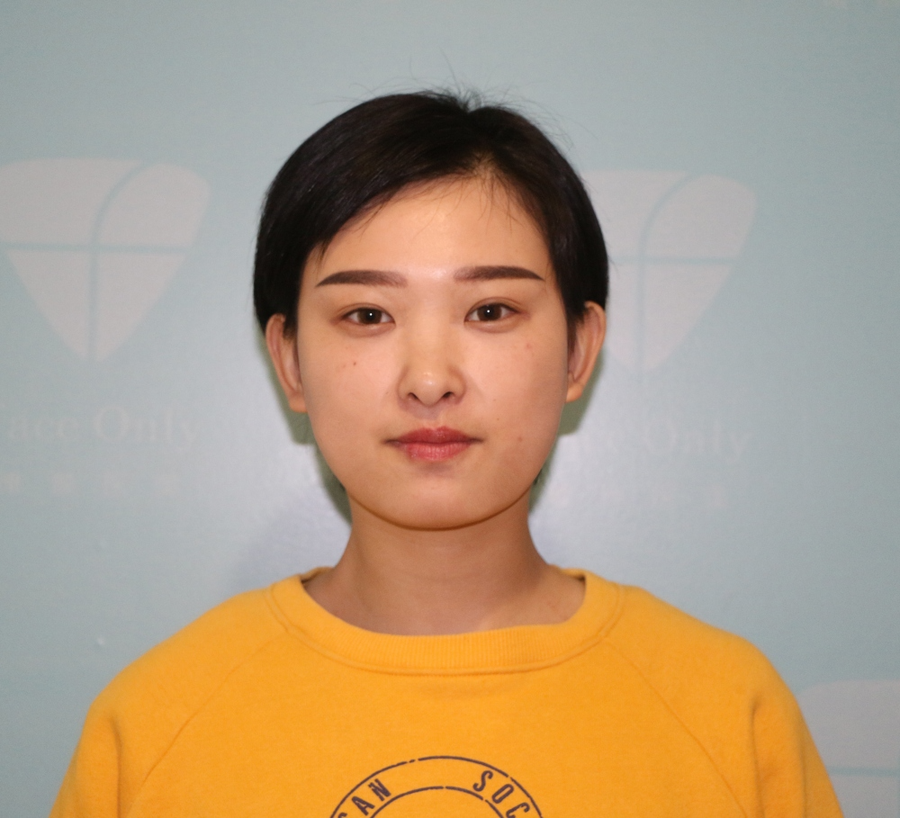 武漢肽慕醫(yī)美整形醫(yī)院楊婉菱醫(yī)生做面部吸脂效果怎么樣？附面部吸脂案例