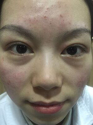 西安壹加壹整形醫(yī)院劉晨醫(yī)生做點(diǎn)陣激光祛痘效果怎么樣？附點(diǎn)陣激光祛痘效果圖