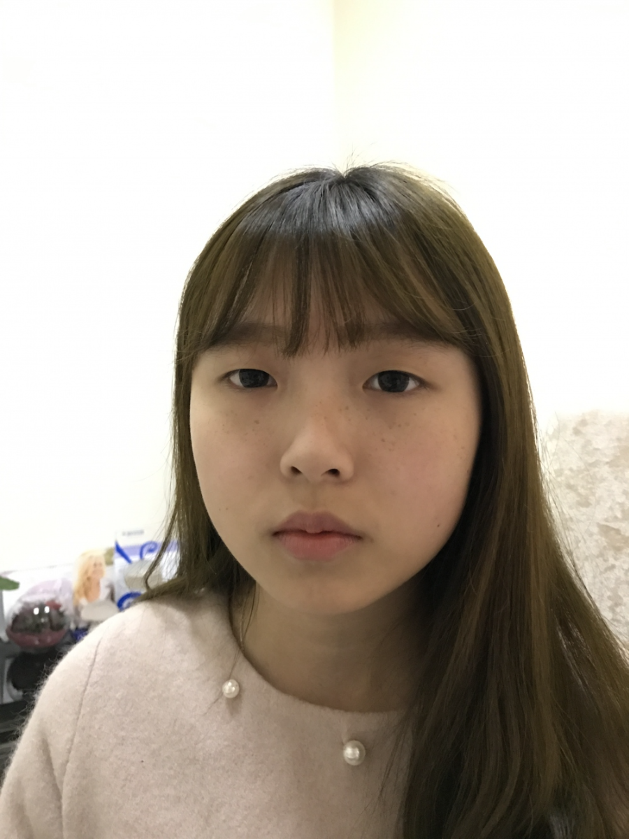 西安米蘭柏羽整形醫(yī)院李旭平做雙眼皮+開眼角技術怎么樣？附醫(yī)院案例