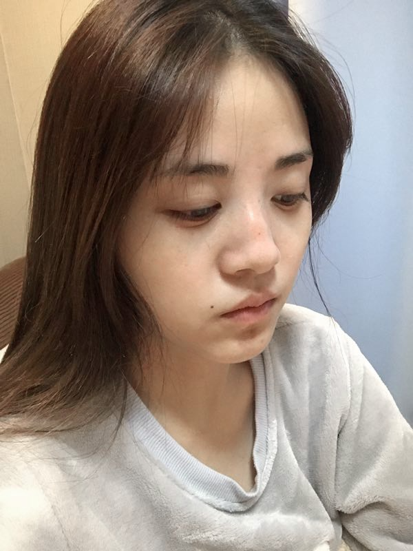駐馬店締萊美醫(yī)療整形醫(yī)生李冰做鼻綜合整形怎么樣？附鼻綜合整形案例效果對比圖