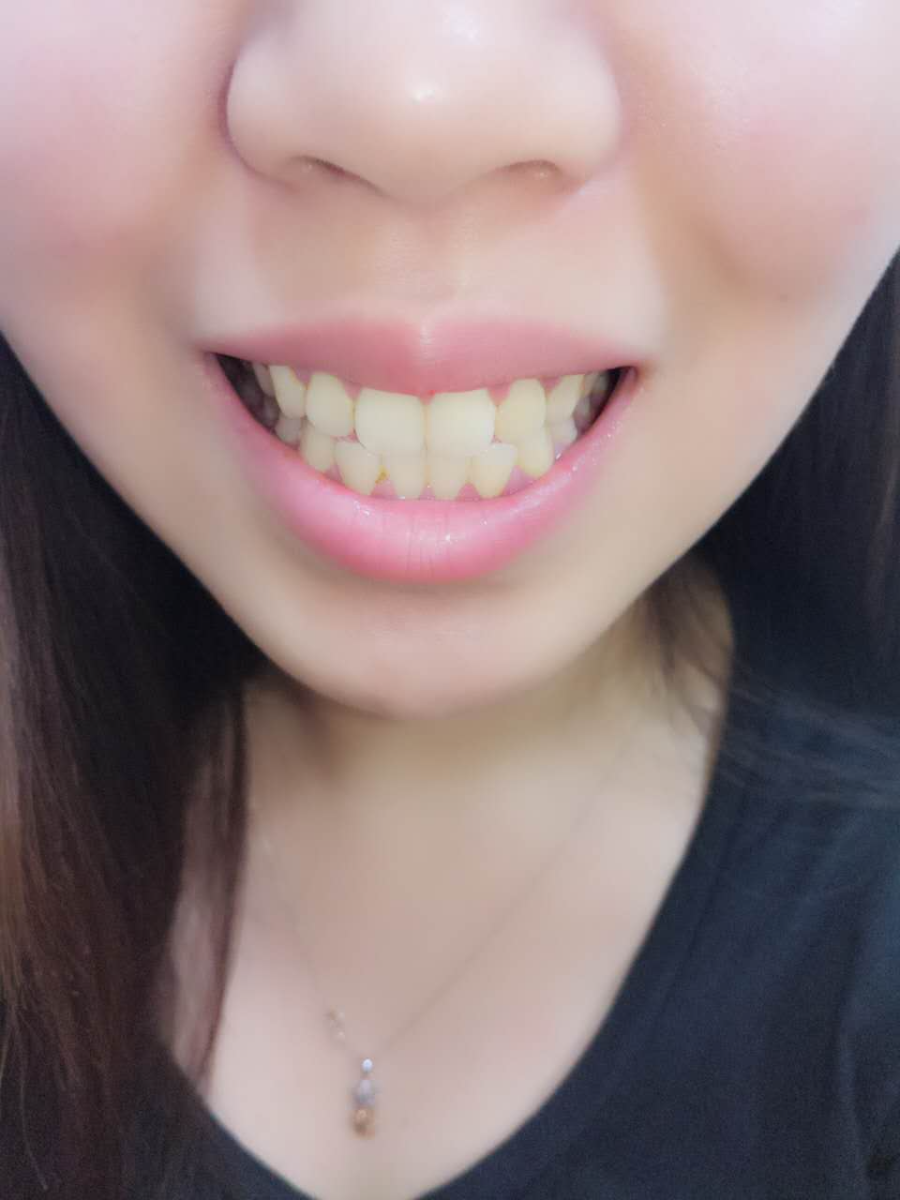 杭州國(guó)雅口腔醫(yī)院張虹醫(yī)生做冷光美白效果怎么樣？附冷光美白案例效果對(duì)比圖