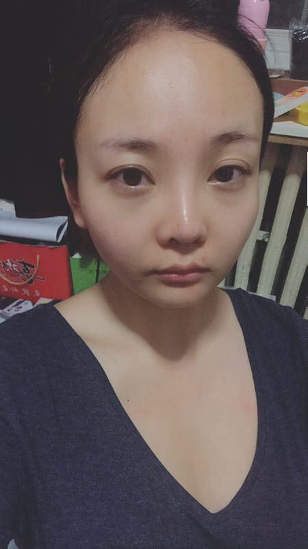 北京可思美醫(yī)療整形醫(yī)生蘇靜做臉部自體脂肪填充效果怎么樣？