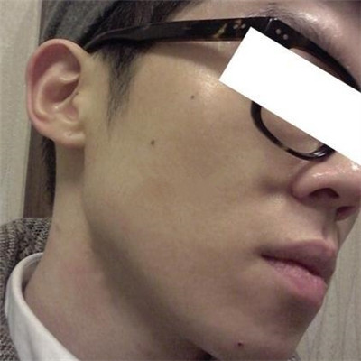浙江綠城醫(yī)院整形美容中心丁路醫(yī)生做激光祛痘效果怎么樣，附案例對比圖