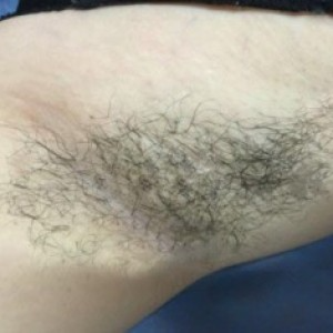 廈門張銘整醫(yī)療整形醫(yī)生張小玲做激光脫腋毛怎么樣？附激光脫腋毛效果對比圖