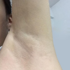 廈門張銘整醫(yī)療整形醫(yī)生張小玲做激光脫腋毛怎么樣？附激光脫腋毛效果對比圖