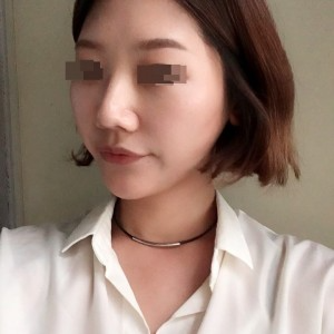 太原麗都整形醫(yī)院劉晉艷醫(yī)生做光纖溶脂瘦臉怎么樣？附案例效果對(duì)比圖