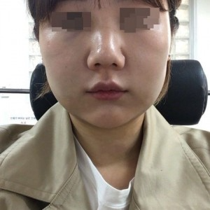 太原麗都整形醫(yī)院劉晉艷醫(yī)生做光纖溶脂瘦臉怎么樣？附案例效果對(duì)比圖