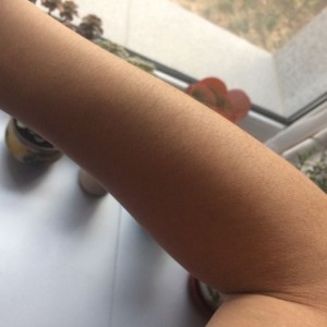 鄭州屈小麗醫(yī)療整形醫(yī)院醫(yī)生劉丹做手臂脫毛怎么樣？附手臂脫毛案例