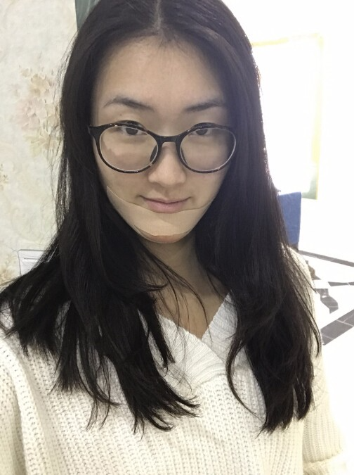 武漢中翰整形外科醫(yī)院做硅膠墊下巴怎么樣？附朱紅霞醫(yī)生案例效果對比圖