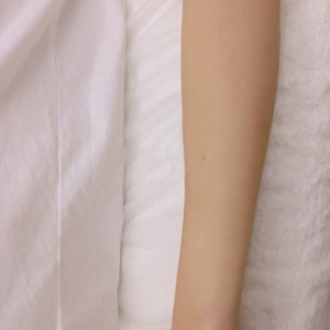 鄭州屈小麗醫(yī)療整形醫(yī)院醫(yī)生劉丹做手臂脫毛怎么樣？附手臂脫毛案例
