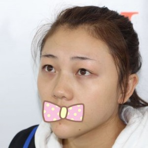 張家口維多利亞整形醫(yī)院張凱醫(yī)生做全切雙眼皮真實案例效果對比圖