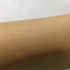 鄭州屈小麗醫(yī)療整形醫(yī)院醫(yī)生劉丹做手臂脫毛怎么樣？附手臂脫毛案例