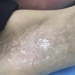廈門張銘整醫(yī)療整形醫(yī)生張小玲做激光脫腋毛怎么樣？附激光脫腋毛效果對(duì)比圖