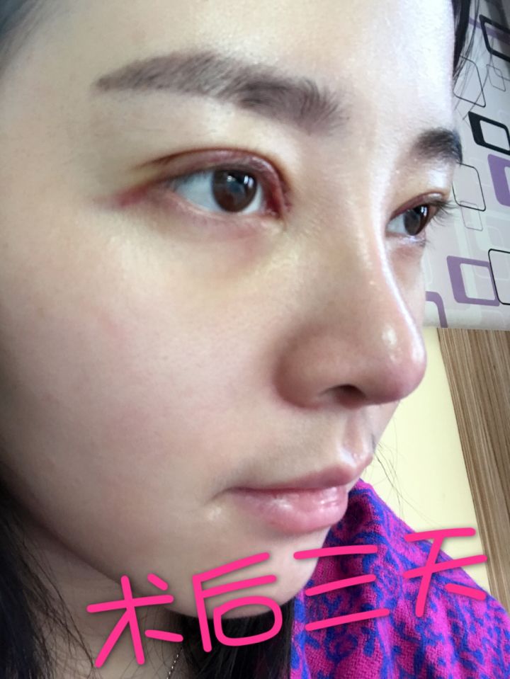 北京京韓整形醫(yī)生王義山做埋線雙眼皮怎么樣？附案例效果對比圖