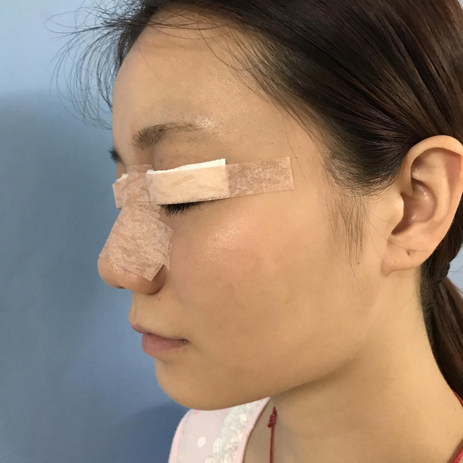 武漢華美整形醫(yī)院醫(yī)生王向陽做眼綜合整形怎么樣？附案例效果圖