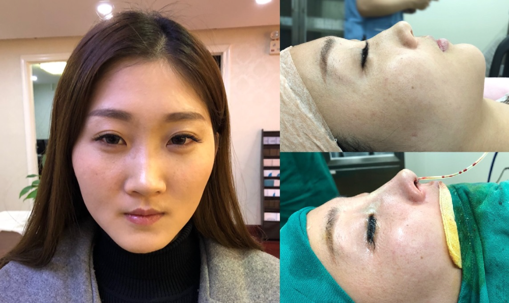 上海首爾麗格醫(yī)療美容醫(yī)院醫(yī)生樸晟秀做膨體隆鼻怎么樣？附案例效果圖