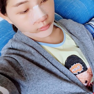 北京京民醫(yī)院整形外科醫(yī)生李鴻儒做硅膠隆鼻怎么樣？附案例效果圖