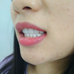 洛陽(yáng)友好口腔醫(yī)院醫(yī)生李新然做牙貼面怎么樣？附案例效果圖