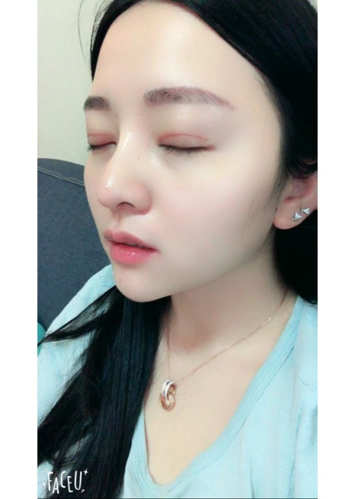 北京京韓整形醫(yī)生王義山做埋線雙眼皮怎么樣？附案例效果對比圖