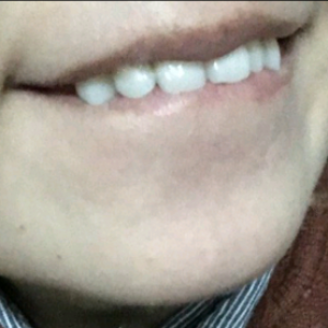 洛陽(yáng)友好口腔醫(yī)院醫(yī)生楊愛芳做牙齒冷光美白怎么樣？附案例效果圖