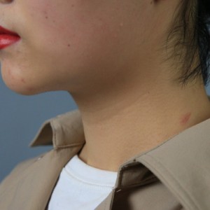 上海名媛醫(yī)療整形醫(yī)生閆嬌君做嗨體去頸紋效果怎么樣？附案例效果圖