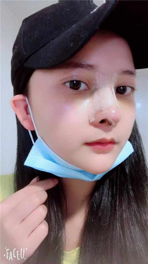 鄭州華領(lǐng)醫(yī)療美容醫(yī)院醫(yī)生張永濤做硅膠假體隆鼻怎么樣？附案例效果對(duì)比圖