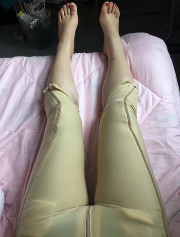 上海保加醫(yī)療美容門診部做大腿吸脂怎么樣？附楊勇醫(yī)生案例效果對比圖