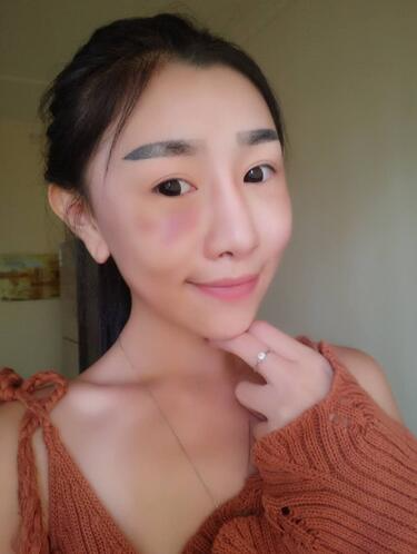 貴陽泰康樂醫(yī)院整形美容科醫(yī)生陳璐做自體脂肪全臉填充效果怎么樣？