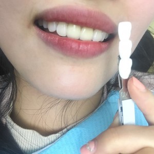 上?？仆呖谇会t(yī)院醫(yī)生鄧建儒做牙齒冷光美白怎么樣？附案例效果對(duì)比圖